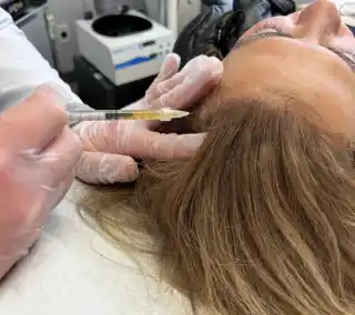 PRF for Hair Loss Treatment
