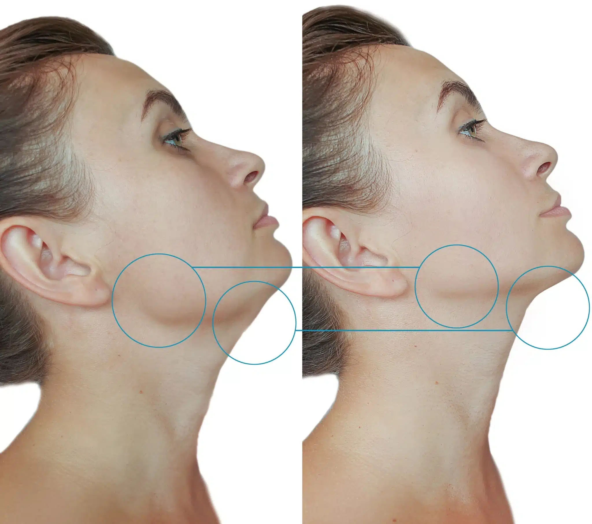 Belkyra Kybella Double Chin Treatment at LMC
