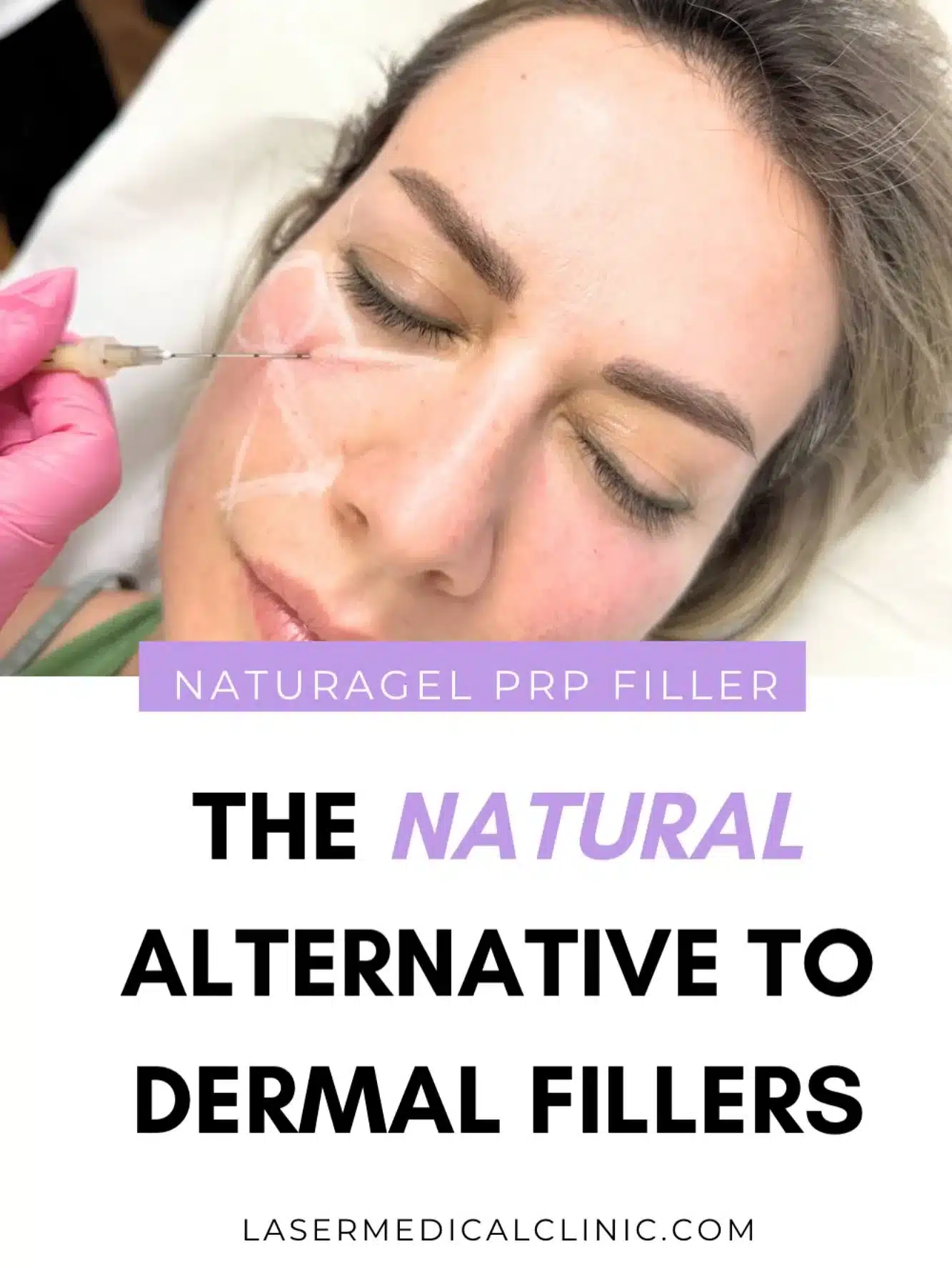NaturaGEL PRP Filler is the natural alternative to dermal fillers