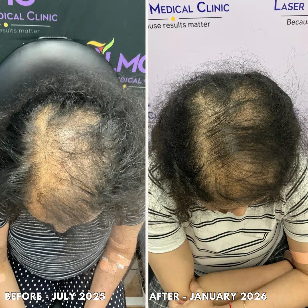 PRP Hair Restoration Before and After Female 2026 PNG