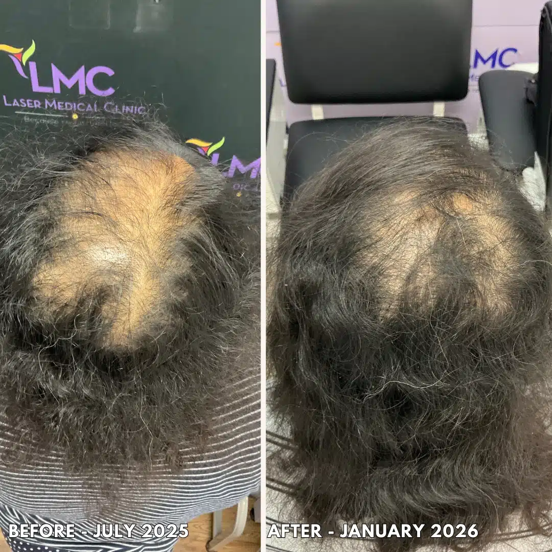 PRP Hair Restoration Before and After Female 2026 Variant