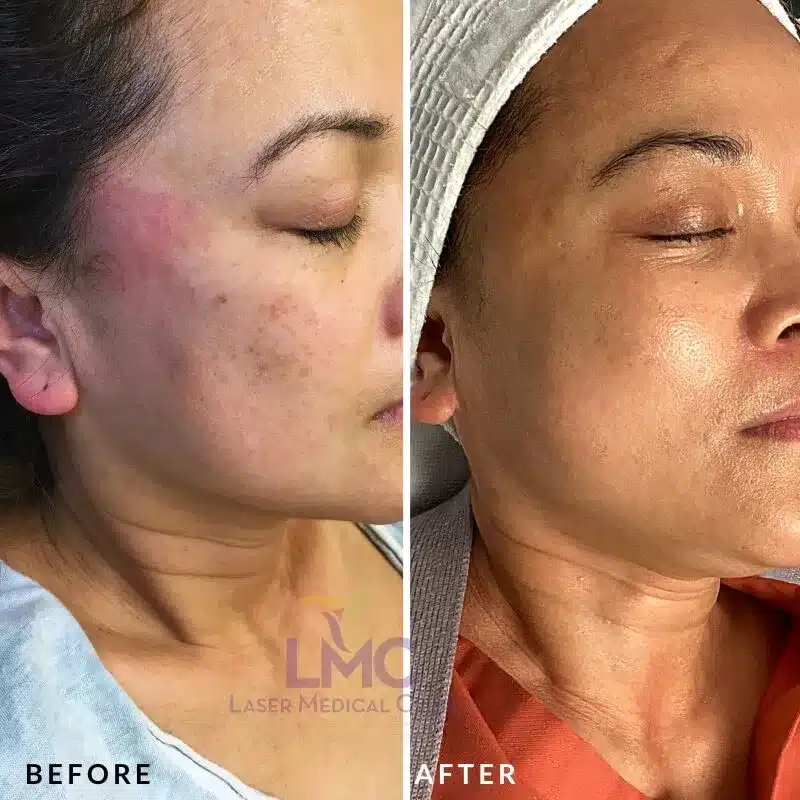 Pico Genesis pigmentation treatment female side view before and after clinical results