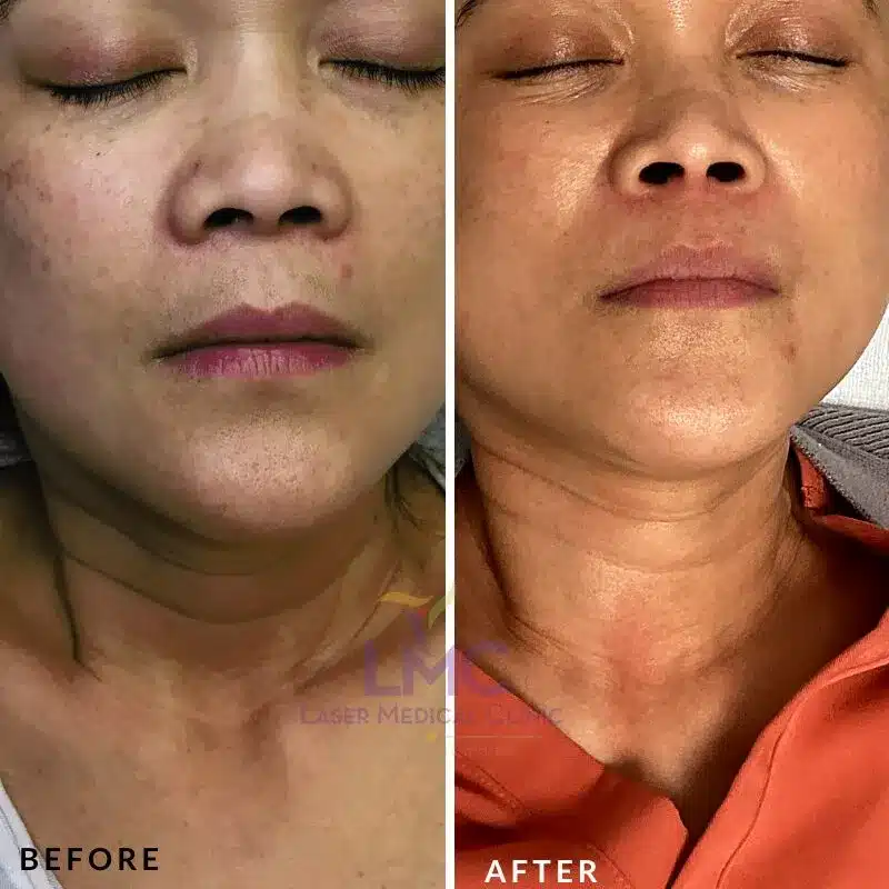 Female frontal hyperpigmentation improvement after Pico Genesis treatment