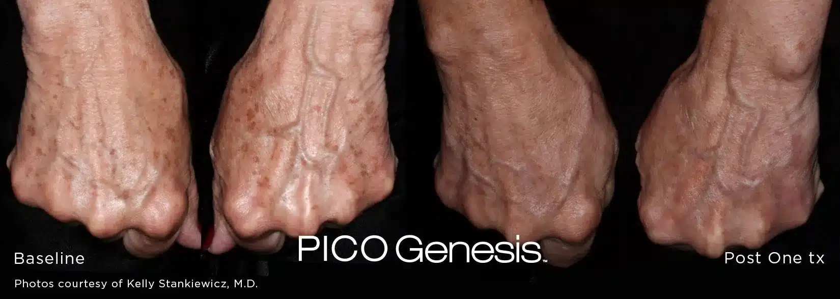 Hand pigmentation removal before and after Pico Genesis