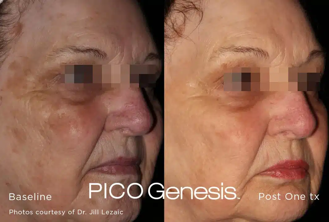 Skin tone revitalization after Pico Genesis treatment