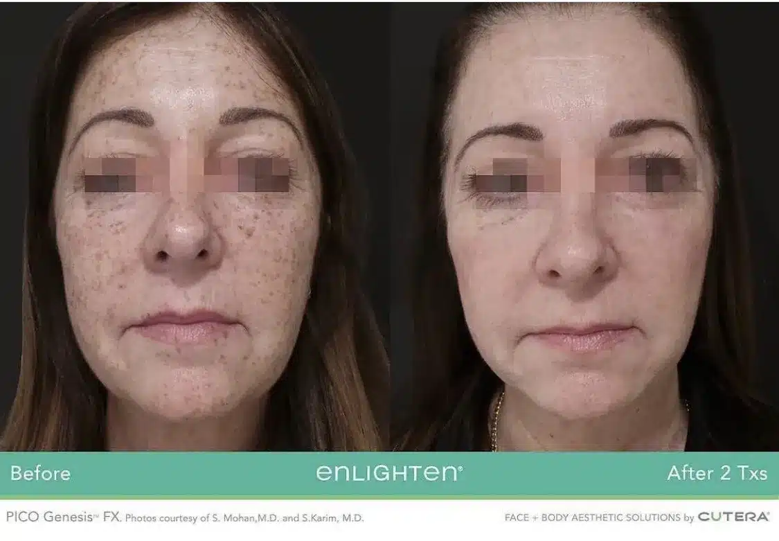 Freckle reduction after Pico Genesis laser treatment