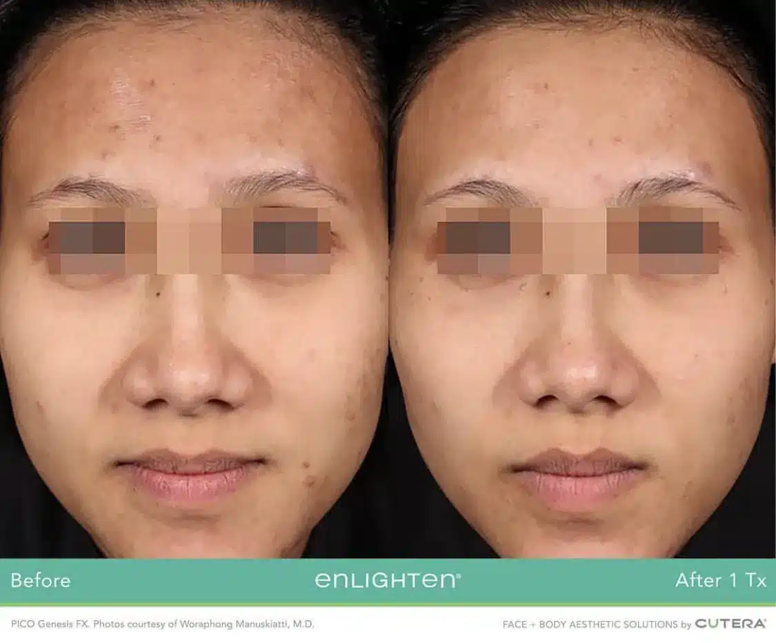 Facial pigmentation reduction clinical comparison photo