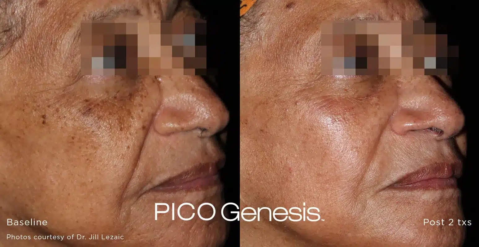 Side view pigment correction after Pico Genesis laser session