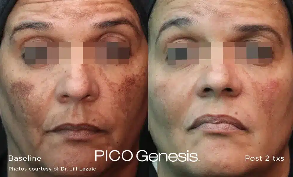 Frontal view before and after Pico Genesis pigmentation removal