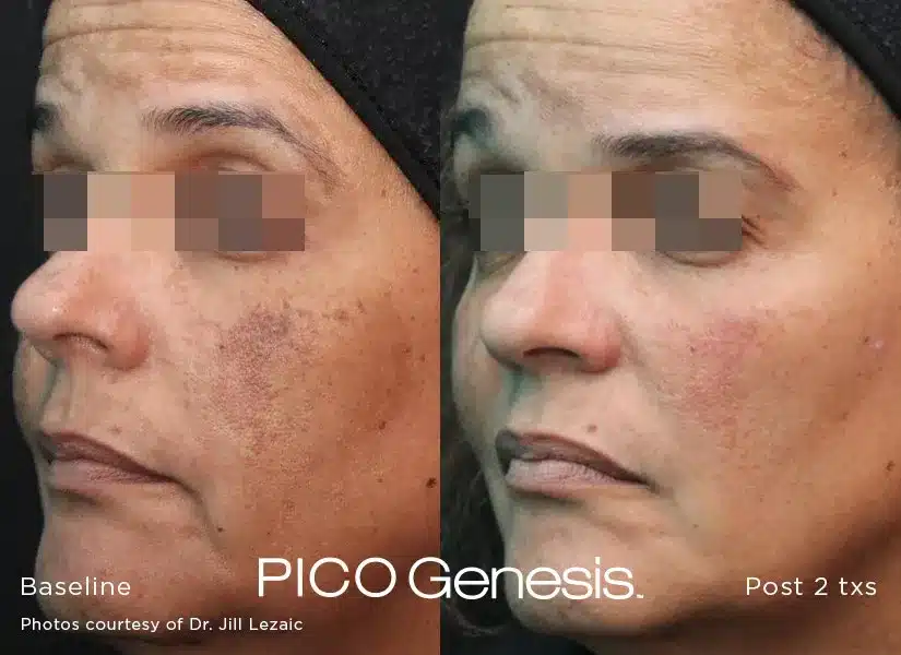 Side profile pigmentation correction clinical results