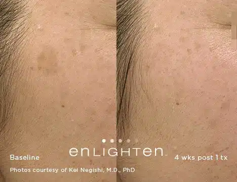 Pigment removal before and after using Pico Genesis laser