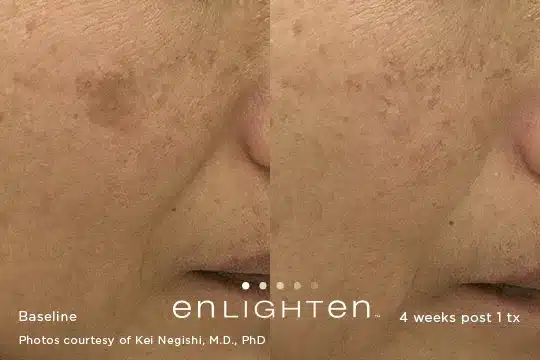 Hyperpigmentation reduction clinical comparison photo