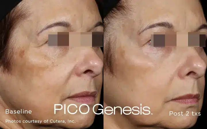 Hyperpigmentation fade after Pico Genesis laser treatment