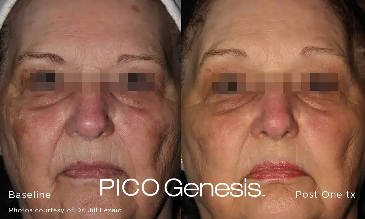 Frontal facial pigmentation improvement after Pico Genesis