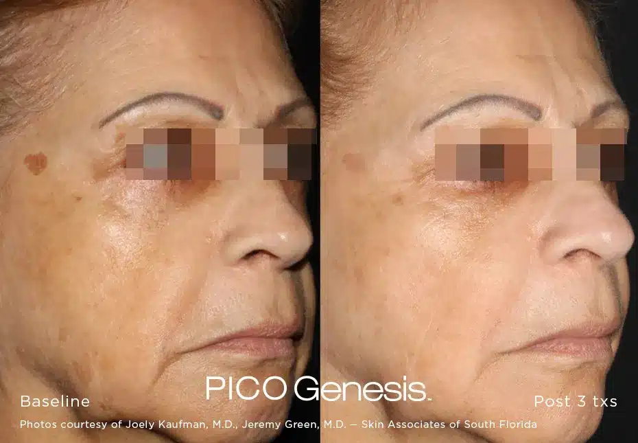 Clinical pigment removal transformation using Pico Genesis