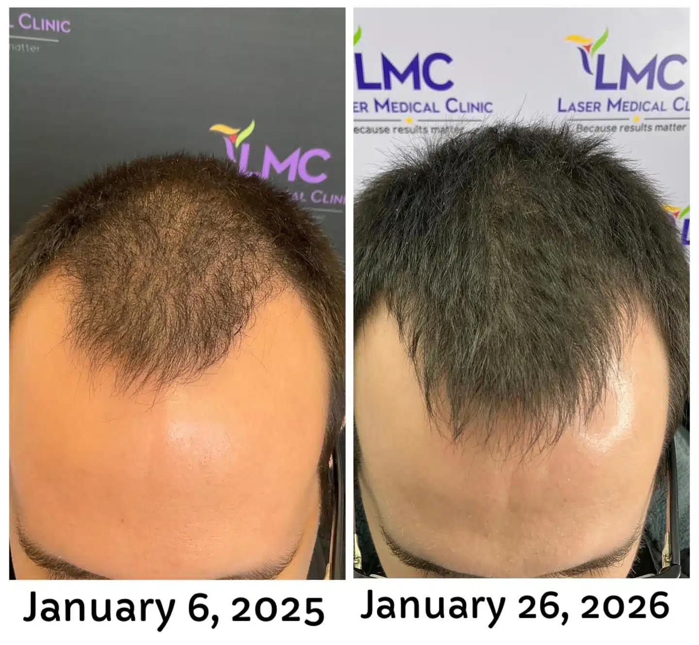 Male receding hairline improvement after PRP hair restoration treatment