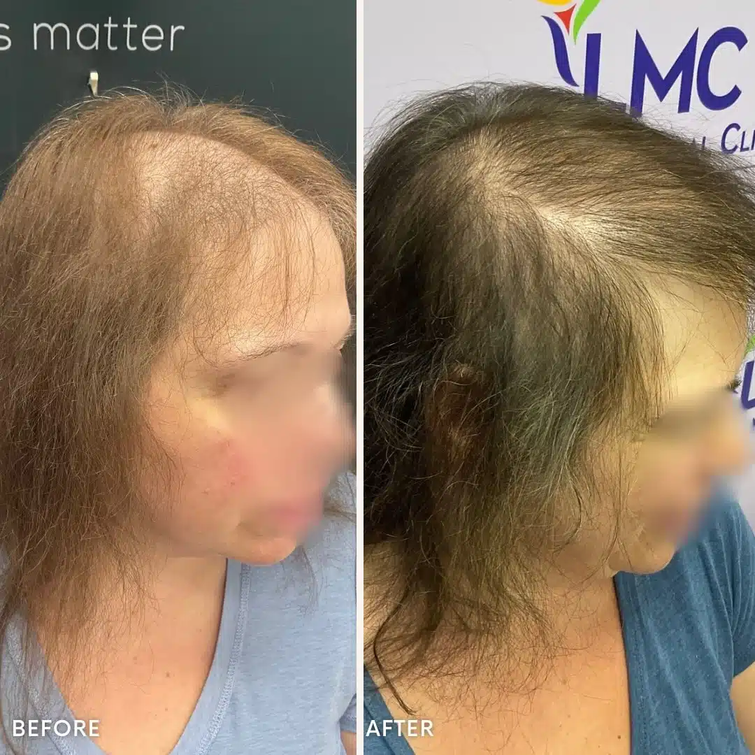 Advanced female hair thinning before and after PRP hair treatment in Richmond Hill