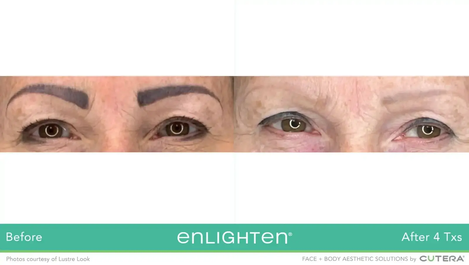 Cosmetic eyebrow tattoo removal before and after four Cutera Enlighten treatments