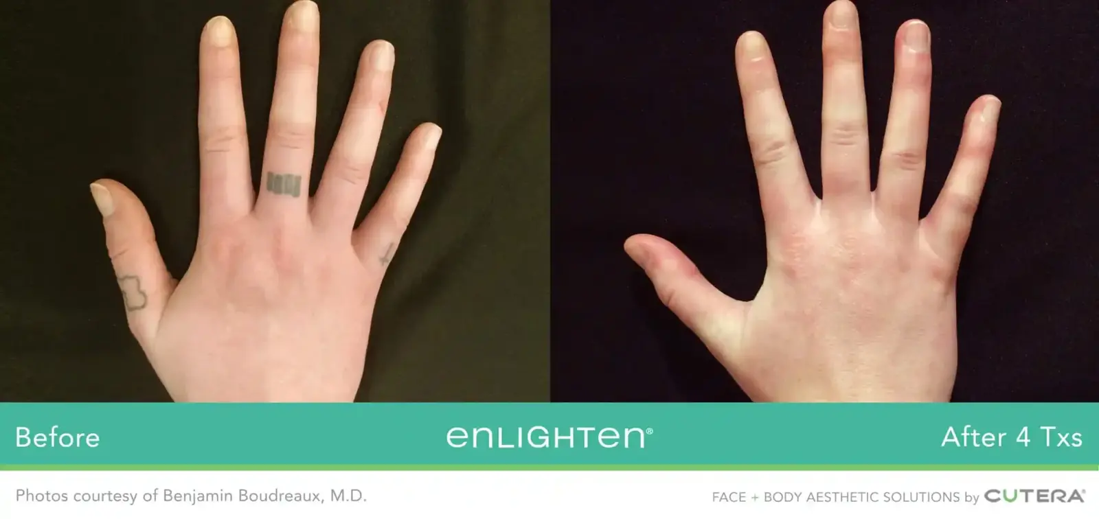 Finger tattoo removal before and after four Cutera Enlighten treatments