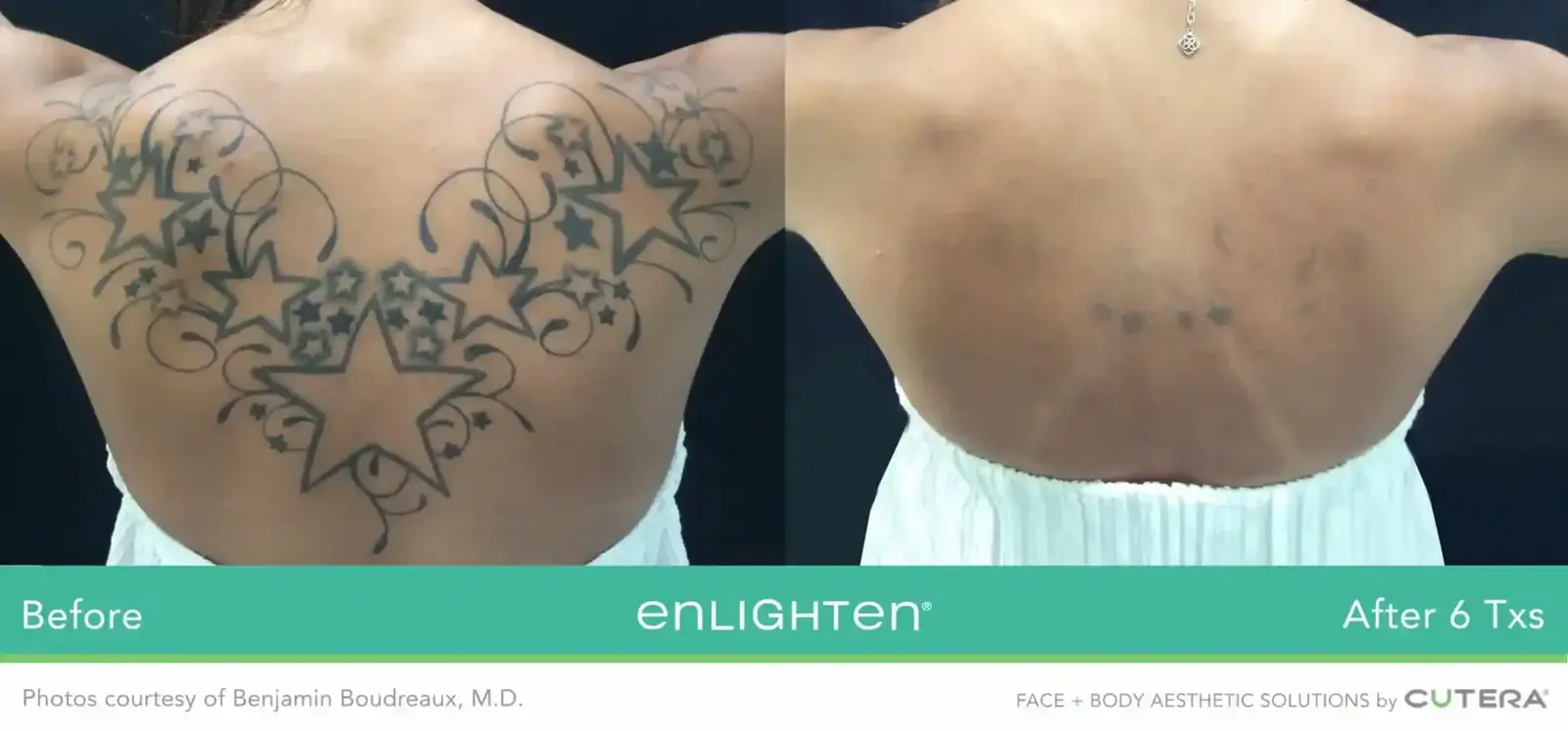 Large upper-back tattoo removal before and after six Cutera Enlighten treatments