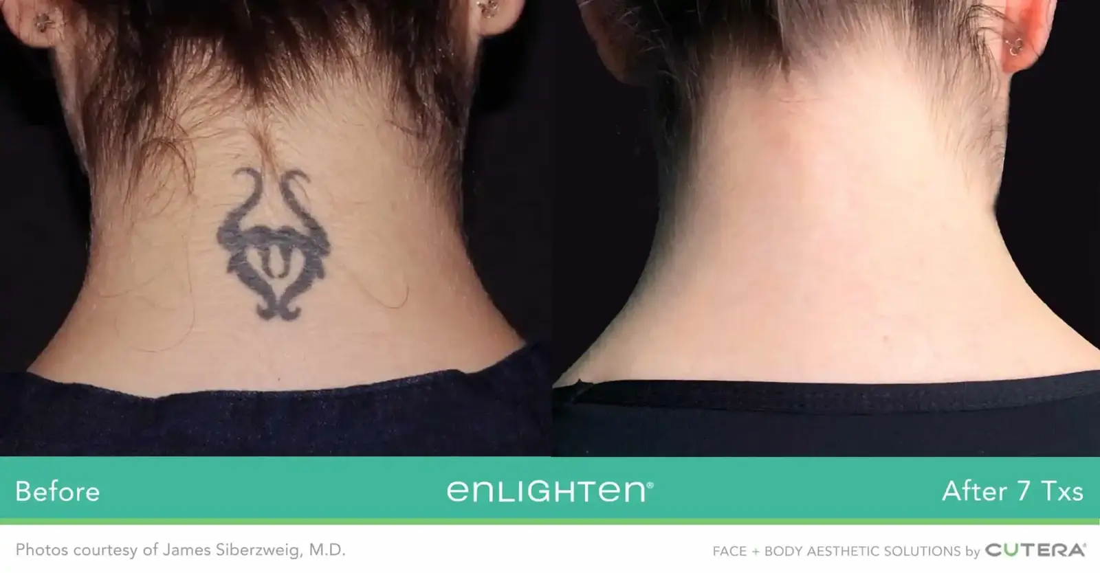 Back-of-neck tattoo removal before and after seven Cutera Enlighten treatments