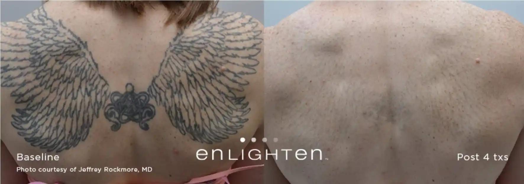 Large wing back tattoo removal before and after four Cutera Enlighten treatments