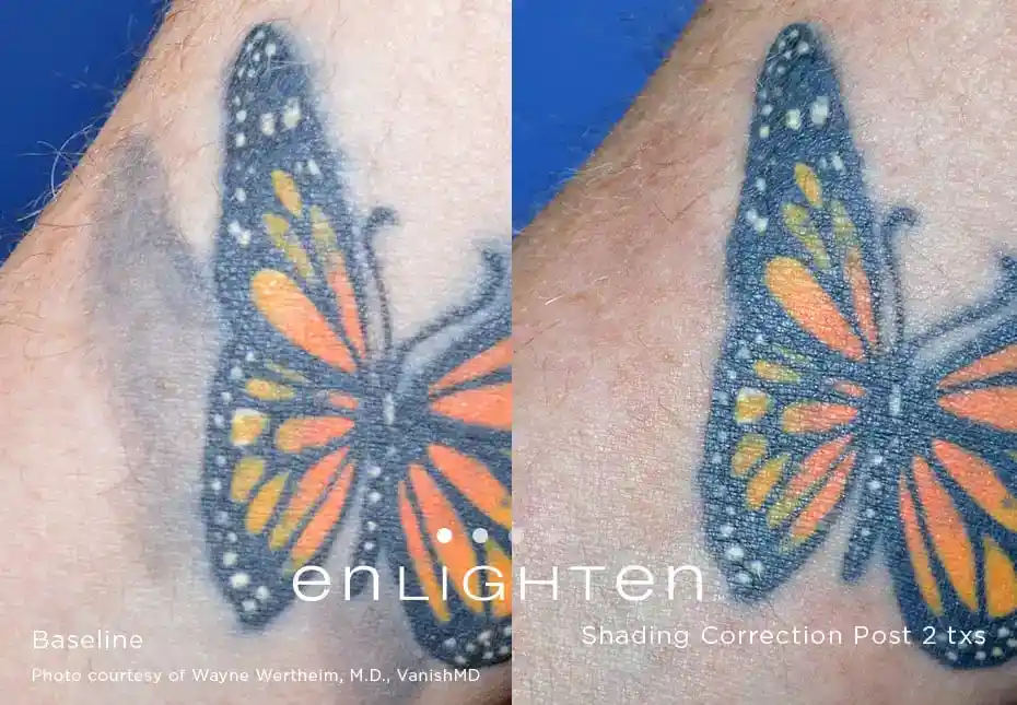 Butterfly tattoo shading correction before and after two Enlighten III laser treatments