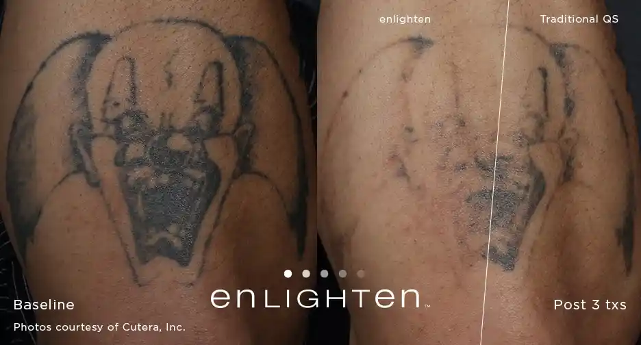 Clown tattoo removal result after three Enlighten III laser treatments