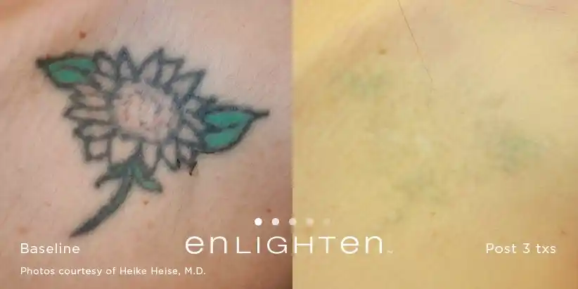 Coloured flower tattoo removal result after three Enlighten III treatments