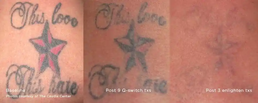 Coloured star and lettering tattoo removal using Q-switched and Enlighten treatments