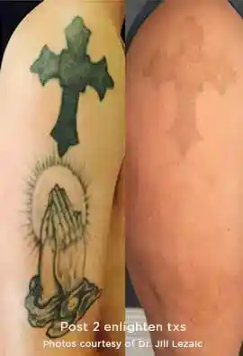 Cross and praying hands tattoo removal after two Enlighten III treatments