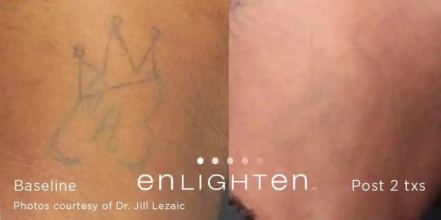 Crown tattoo fading before and after two Enlighten III treatments