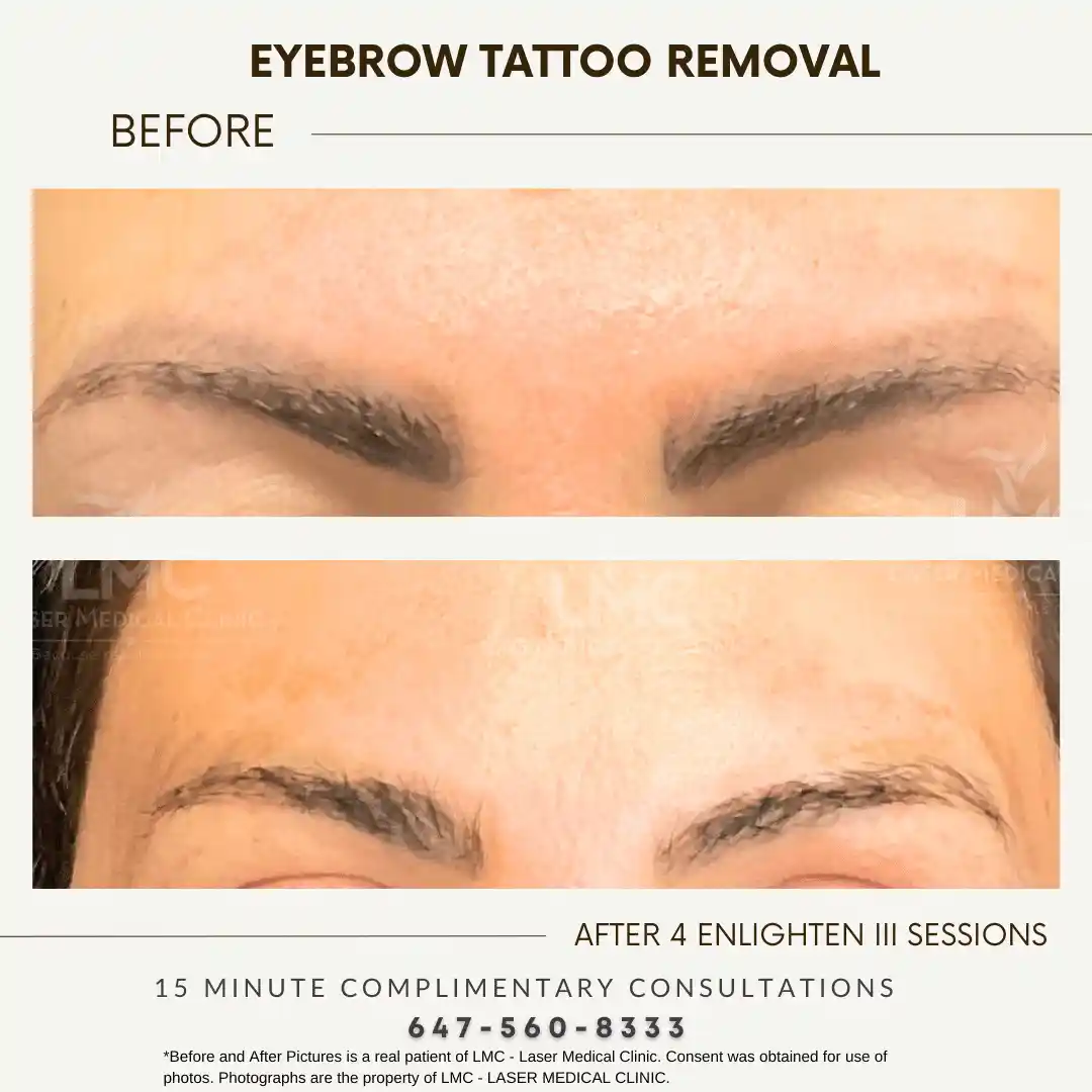 Eyebrow tattoo removal before and after four Enlighten III sessions at LMC in Toronto