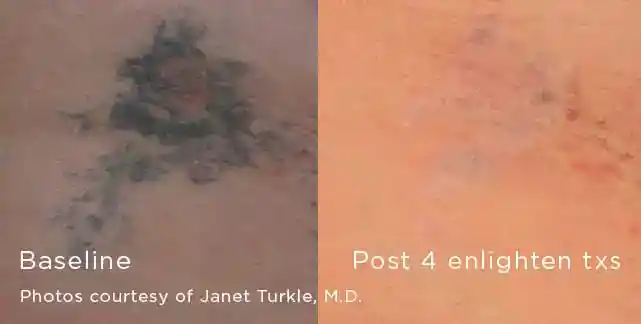 Faded flower tattoo removal before and after four Enlighten III treatments