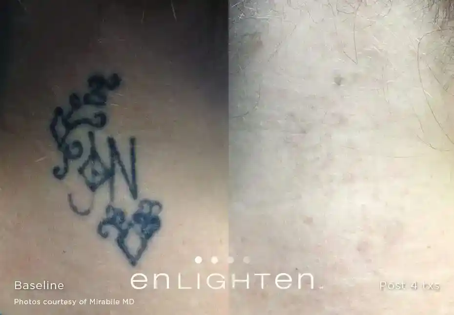 Floral initials tattoo removal before and after four Enlighten III laser treatments