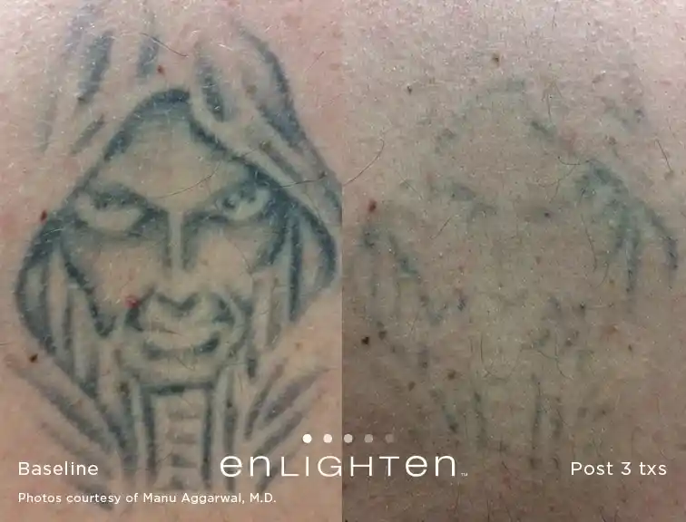 Grim Reaper tattoo fading before and after three Enlighten III treatments