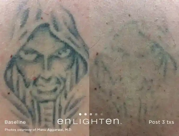 Grim Reaper tattoo removal before and after three Enlighten III treatments