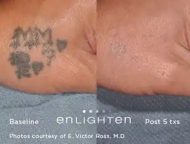 Small hand tattoo removal before and after five Enlighten III treatments