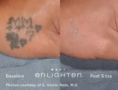 Hand and wrist tattoo removal before and after five Enlighten III treatments