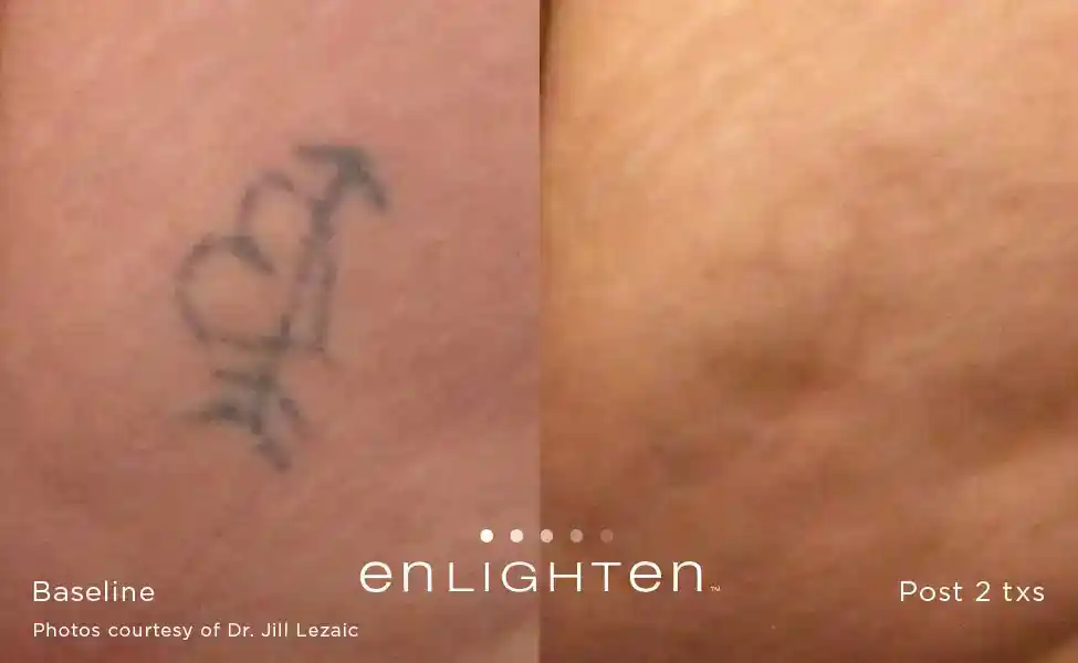 Heart symbol tattoo removal before and after two Enlighten III treatments