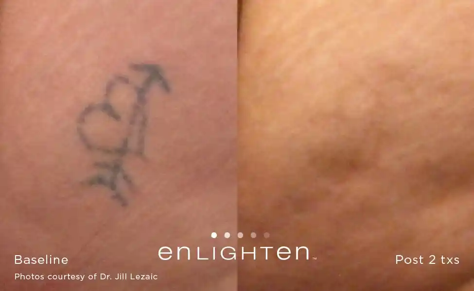 Small heart tattoo removal before and after two Enlighten III treatments