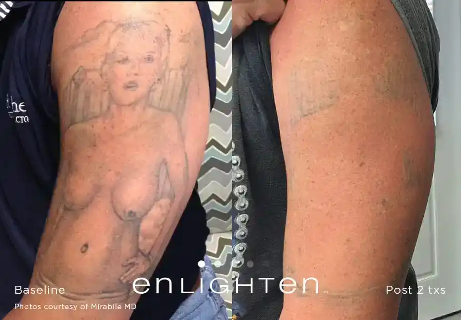 Large arm portrait tattoo removal before and after two Enlighten III treatments