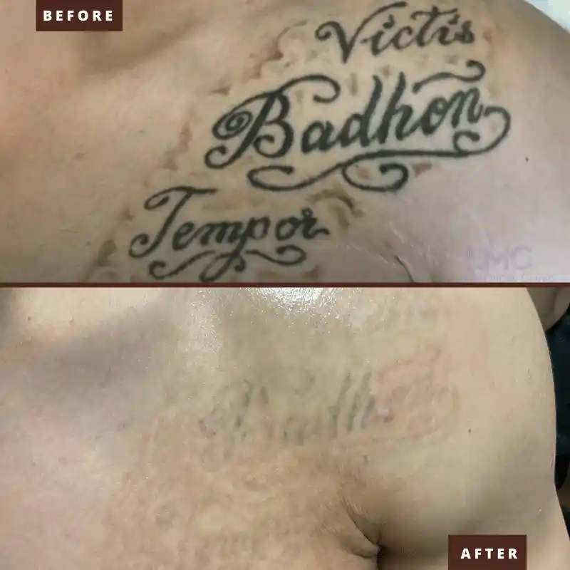 Large lettering tattoo removal before and after Enlighten III treatment at LMC