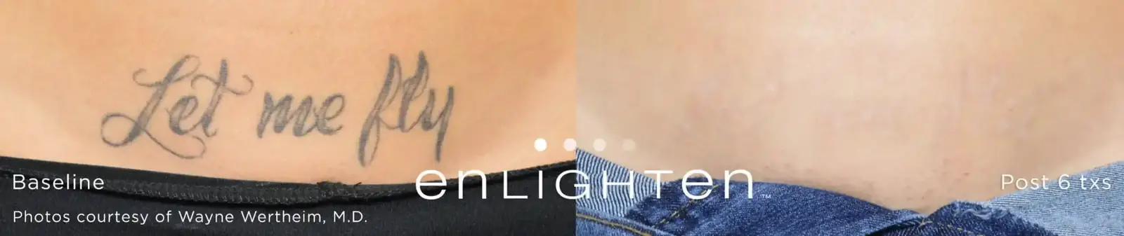 Script lettering tattoo removal before and after six Enlighten III treatments