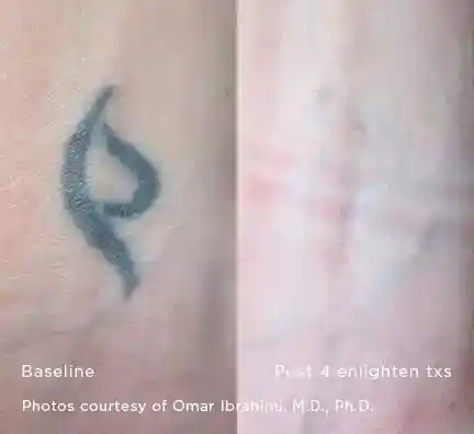 Small black symbol tattoo removal before and after four Enlighten III treatments