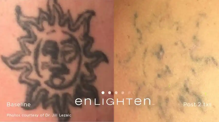 Sun design tattoo fading before and after two Enlighten III treatments