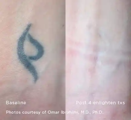 Black symbol tattoo removal before and after four Enlighten III treatments