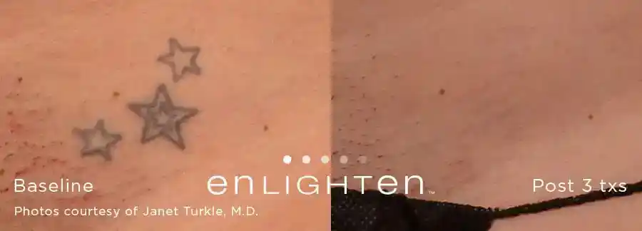 Three-star tattoo removal before and after three Enlighten III treatments