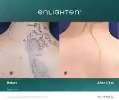 Upper-back tattoo removal before and after three Enlighten laser treatments