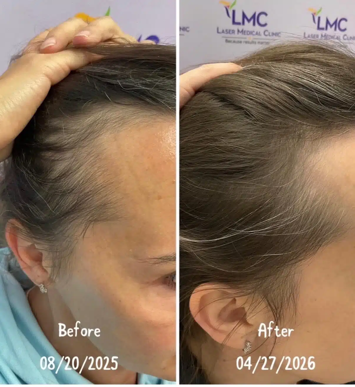 Female hairline thinning before and after PRP hair treatment in Richmond Hill
